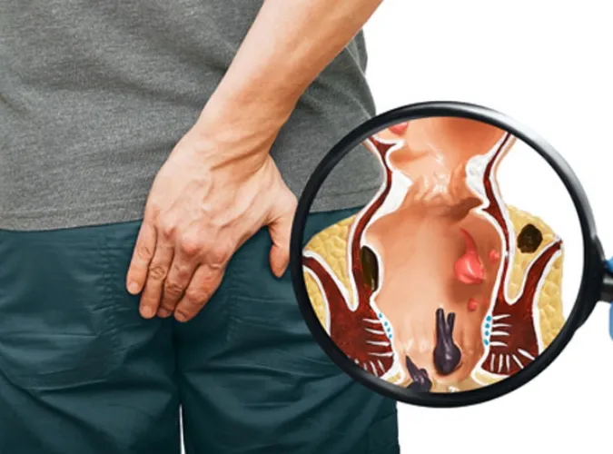 Certificate Course In Ayurvedic Management Of Ano Rectal Disorders